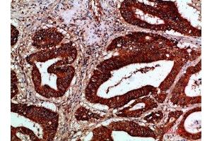 Immunohistochemical analysis of paraffin-embedded human-colon-cancer, antibody was diluted at 1:200