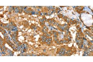 Immunohistochemistry of paraffin-embedded Human thyroid cancer using PYGL Polyclonal Antibody at dilution of 1:35 (PYGL anticorps)