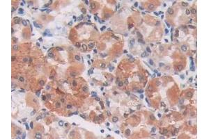 Detection of S100A5 in Human Stomach cancer Tissue using Monoclonal Antibody to S100 Calcium Binding Protein A5 (S100A5)