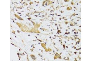 Immunohistochemistry of paraffin-embedded Human liver cancer using GPD2 Polyclonal Antibody at dilution of 1:100 (40x lens).
