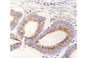 IHC analysis of FFPE human colon carcinoma tissue stained with GDF11 antibody (GDF11 anticorps  (AA 32-61))