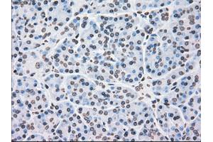 Immunohistochemical staining of paraffin-embedded Adenocarcinoma of colon tissue using anti-PLK1mouse monoclonal antibody. (PLK1 anticorps)