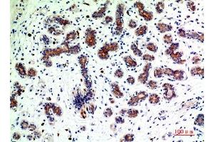 Immunohistochemical analysis of paraffin-embedded human-breast-cancer, antibody was diluted at 1:200 (BMP2 anticorps  (C-Term))