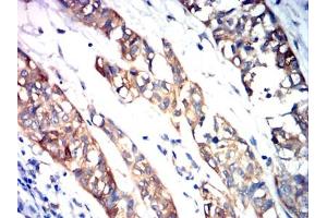 Immunohistochemical analysis of paraffin-embedded baldder cancer tissues using HIF2a mouse mAb with DAB staining.