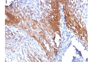 Formalin-fixed, paraffin-embedded human Cervical Carcinoma stained with CK17 Mouse Monoclonal Antibody (KRT17/778). (KRT17 anticorps)
