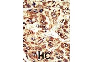 Formalin-fixed and paraffin-embedded human cancer tissue reacted with the primary antibody, which was peroxidase-conjugated to the secondary antibody, followed by AEC staining.