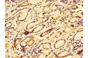 Immunohistochemistry of paraffin-embedded human gastric cancer using ABIN7172505 at dilution of 1:100 (DP2 anticorps  (AA 344-386))