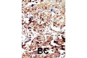 Formalin-fixed and paraffin-embedded human cancer tissue reacted with the primary antibody, which was peroxidase-conjugated to the secondary antibody, followed by AEC staining.