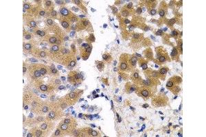 Immunohistochemistry of paraffin-embedded Human liver cancer using SCP2 Polyclonal Antibody at dilution of 1:200 (40x lens).