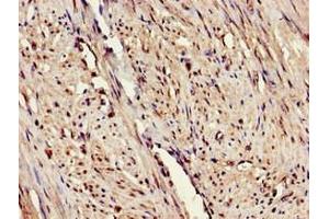 Immunohistochemistry of paraffin-embedded human endometrial cancer using ABIN7151655 at dilution of 1:100 (ERAP1 anticorps  (AA 642-941))