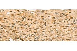 Immunohistochemistry of paraffin-embedded Human cervical cancer tissue using SCMH1 Polyclonal Antibody at dilution of 1:120(x200)