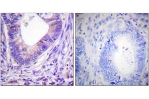 Immunohistochemistry analysis of paraffin-embedded human colon carcinoma tissue, using PKA alpha/beta CAT (Ab-197) Antibody. (PKA alpha/beta Cat (AA 166-215) anticorps)
