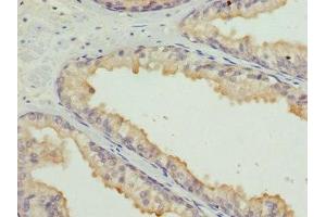 Immunohistochemistry of paraffin-embedded human prostate cancer using ABIN7155205 at dilution of 1:100