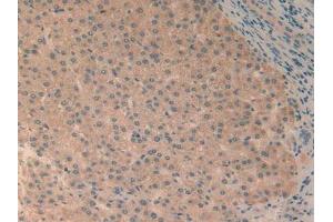 IHC-P analysis of Human Liver Cancer Tissue, with DAB staining. (RELB anticorps  (AA 248-492))