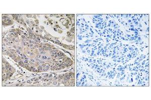 Immunohistochemistry analysis of paraffin-embedded human lung carcinoma tissue using PLA2G4E antibody.