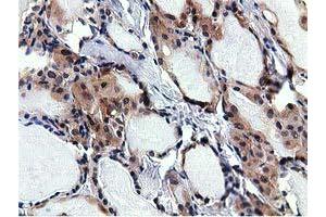 Immunohistochemical staining of paraffin-embedded Carcinoma of Human thyroid tissue using anti-RBBP9 mouse monoclonal antibody. (RBBP9 anticorps)