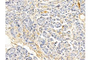 ABIN6260508 and ABIN6268919 at 1/100 staining Human pancreatic cancer and adjacent nomal tissues by IHC-P. (Caveolin-1 anticorps  (C-Term))