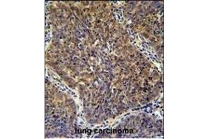 CD2BP2 Antibody (N-term) (ABIN654903 and ABIN2844551) immunohistochemistry analysis in formalin fixed and paraffin embedded human lung carcinoma followed by peroxidase conjugation of the secondary antibody and DAB staining.