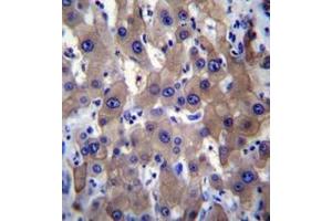 Immunohistochemistry analysis in formalin fixed and paraffin embedded human liver tissue reacted with MLXIPL Antibody (C-term) followed by peroxidase conjugation of the secondary antibody and DAB staining.