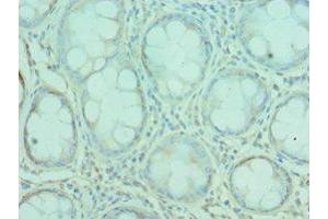 Immunohistochemistry of paraffin-embedded human colon cancer using ABIN7167157 at dilution of 1:100