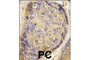 Formalin-fixed and paraffin-embedded human prostata carcinoma tissue reacted with Latexin antibody , which was peroxidase-conjugated to the secondary antibody, followed by DAB staining.