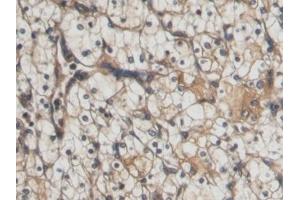 Detection of CTGF in Human Renal cancer Tissue using Polyclonal Antibody to Connective Tissue Growth Factor (CTGF)