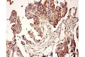 IHC-P: CNTF antibody testing of human intestine cancer tissue