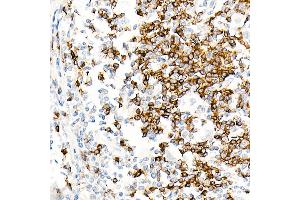 Immunohistochemistry of paraffin-embedded Human Hodgkin lymphoma using IGHD antibody (ABIN7267824) at dilution of 1:100 (40x lens). (IgD anticorps)