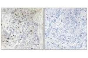 Immunohistochemistry analysis of paraffin-embedded human breast carcinoma tissue, using MAFF antibody. (MafF anticorps)