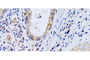 Immunohistochemistry of paraffin-embedded Human gastric cancer using PTGIR Polyclonal Antibody at dilution of 1:200 (40x lens). (Prostacyclin Receptor anticorps)