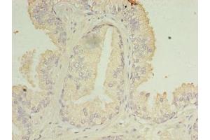 Immunohistochemistry of paraffin-embedded human prostate cancer using ABIN7166819 at dilution of 1:100 (C11ORF45 anticorps  (AA 23-145))
