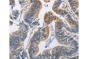 Immunohistochemistry of Human colon cancer using PGK1 Polyclonal Antibody at dilution of 1:50 (PGK1 anticorps)
