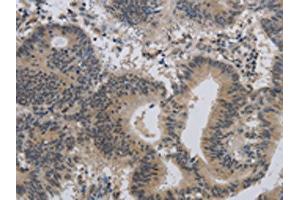 The image on the left is immunohistochemistry of paraffin-embedded Human colon cancer tissue using ABIN7189784(ALX4 Antibody) at dilution 1/20, on the right is treated with synthetic peptide.