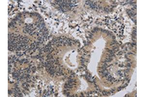 The image on the left is immunohistochemistry of paraffin-embedded Human colon cancer tissue using ABIN7189784(ALX4 Antibody) at dilution 1/20, on the right is treated with synthetic peptide. (ALX4 anticorps)