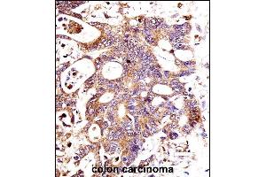 CTNNB1 Antibody (C-term) immunohistochemistry analysis in formalin fixed and paraffin embedded human colon carcinoma followed by peroxidase conjugation of the secondary antibody and DAB staining.