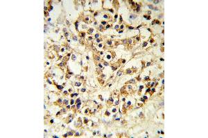 FGFR1 Antibody i IHC analysis in formalin fixed and paraffin embedded human breast carcinoma followed by peroxidase conjugation of the secondary antibody and DAB staining. (FGFR1 anticorps)