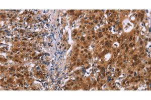 Immunohistochemistry of paraffin-embedded Human gastic cancer using CBX3 Polyclonal Antibody at dilution of 1:40