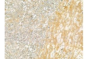 ABIN6257110 and ABIN6274624 at 1/100 staining human Hodgkin lymphoma by IHC-P.