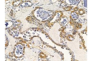 ABIN7093923 and ABIN7097967 at 1/100 staining human ovarian cancer by IHC-P. (NCS1 anticorps  (C-Term))