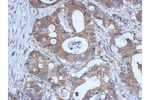 IHC-P Image Immunohistochemical analysis of paraffin-embedded human gastric cancer, using GPX2, antibody at 1:500 dilution. (Glutathione Peroxidase 2 anticorps  (C-Term))