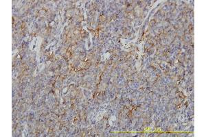 Immunoperoxidase of monoclonal antibody to CORO1B on formalin-fixed paraffin-embedded human lymphoma tissue.