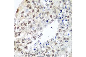 Immunohistochemistry of paraffin-embedded human lung cancer using PTTG1 antibody at dilution of 1:100 (40x lens).