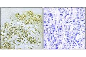 Immunohistochemistry analysis of paraffin-embedded human breast carcinoma, using IkappaB-alpha (Phospho-Tyr42) Antibody.