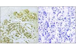 Immunohistochemistry analysis of paraffin-embedded human breast carcinoma, using IkappaB-alpha (Phospho-Tyr42) Antibody. (NFKBIA anticorps  (pTyr42))