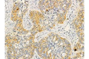 SDF4 Mouse Monoclonal Antibody at 1/100 staining human lung cancer by IHC-P. (SDF4 anticorps)