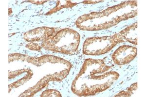 Formalin-fixed, paraffin-embedded human Prostate Carcinoma stained with YBX1 Mouse Monoclonal Antibody (YBX1/2430) (YBX1 anticorps)