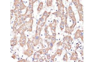 Immunohistochemistry of paraffin-embedded Human liver cancer using ATP5A1 Polyclonal Antibody at dilution of 1:100 (40x lens).