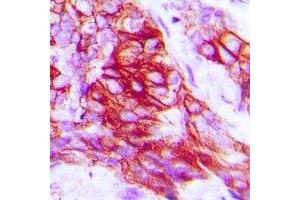 Immunohistochemical analysis of Syntaxin 1A (pS14) staining in human prostate cancer formalin fixed paraffin embedded tissue section.