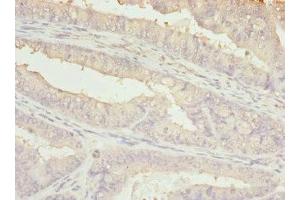 Immunohistochemistry of paraffin-embedded human endometrial cancer using ABIN7145239 at dilution of 1:100