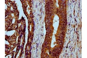 IHC image of ABIN7158674 diluted at 1:300 and staining in paraffin-embedded human colon cancer performed on a Leica BondTM system. (LYRM4 anticorps  (AA 1-91))
